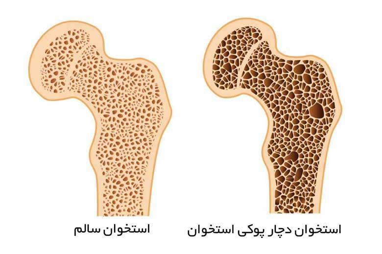 عوامل پوکی استخوان زودتر از 50 سالگی بروز می کند